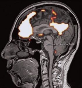 figuur 1 fmri studie aan hersenen voor diagnose elektrohypersensitiviteit ehs