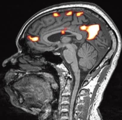 figuur 2 fmri studie aan hersenen voor diagnose elektrohypersensitiviteit ehs